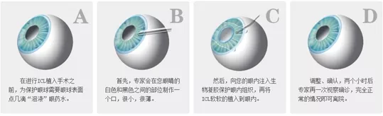 中牟眼健康|近视手术方式繁多，教你怎么选？