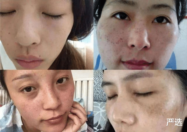 严选|连续打了6年“美白针”的女人，如今怎么样了？网友：难以置信