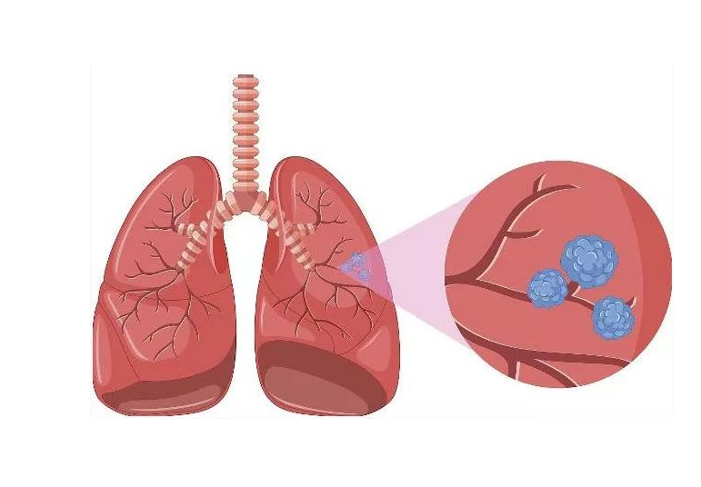 千金芳|?吃一口胜过3斤雪梨,呼吸科医生提醒:若你爱吃,止咳散结,肺结节一天天好转