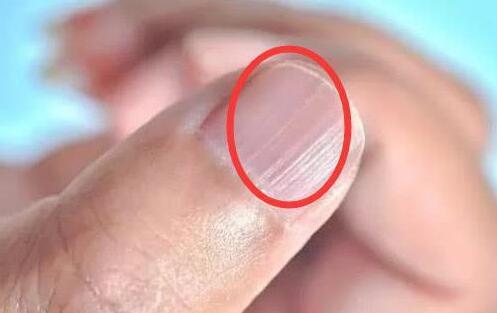 白血病|指甲出现竖纹是身体不好的表现么？