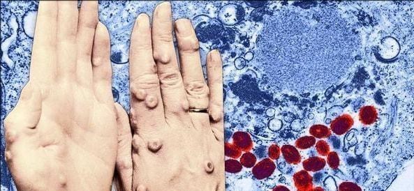 科学家 天花病毒到底多么恐怖？过去这么久，如今依然是科学家担心的问题