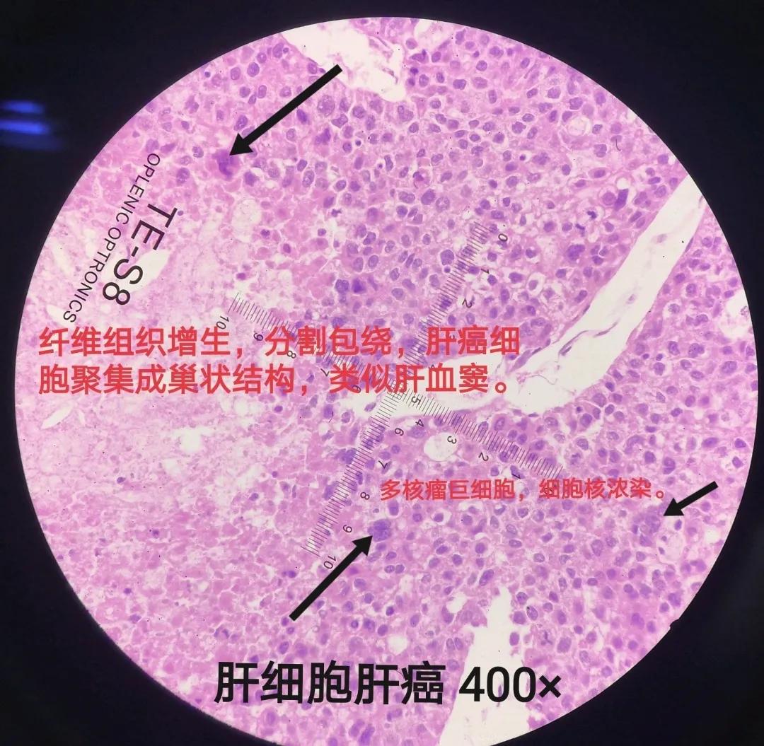 水果|酒不沾的老板娘夫妇双双被查出癌症！竟跟他们卖的这种水果有关。