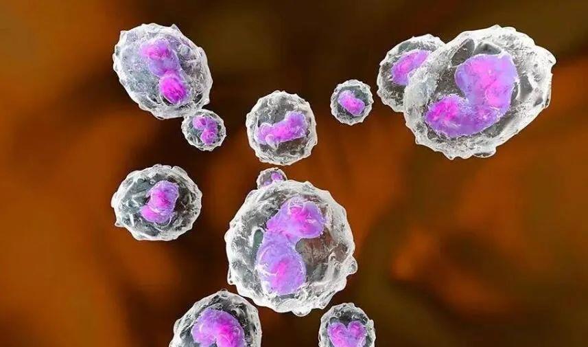 系统性红斑狼疮 干细胞治疗系统性红斑狼疮临床疗效亮眼
