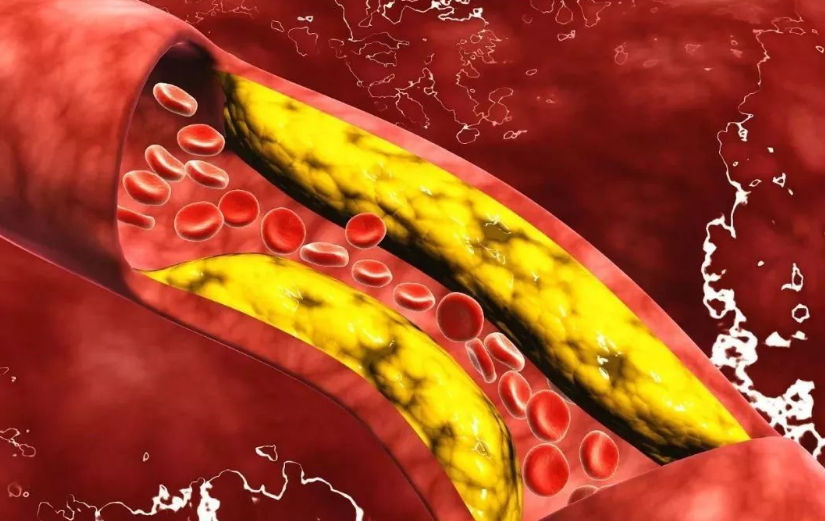 血栓|血栓“清道夫”找到了！大蒜排第三，排在第一很多人并不知道