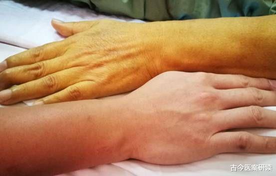 肝癌|肝癌“上身”，手部先知！医生：手部若有3种表现，趁早检查肝功