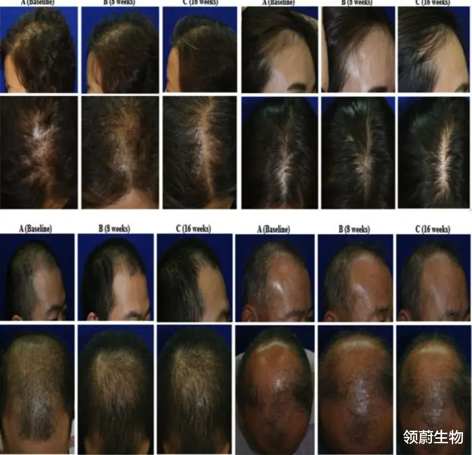 领蔚生物 脱发与秃顶遇上了干细胞技术, 或许医学难题变成了奇迹!