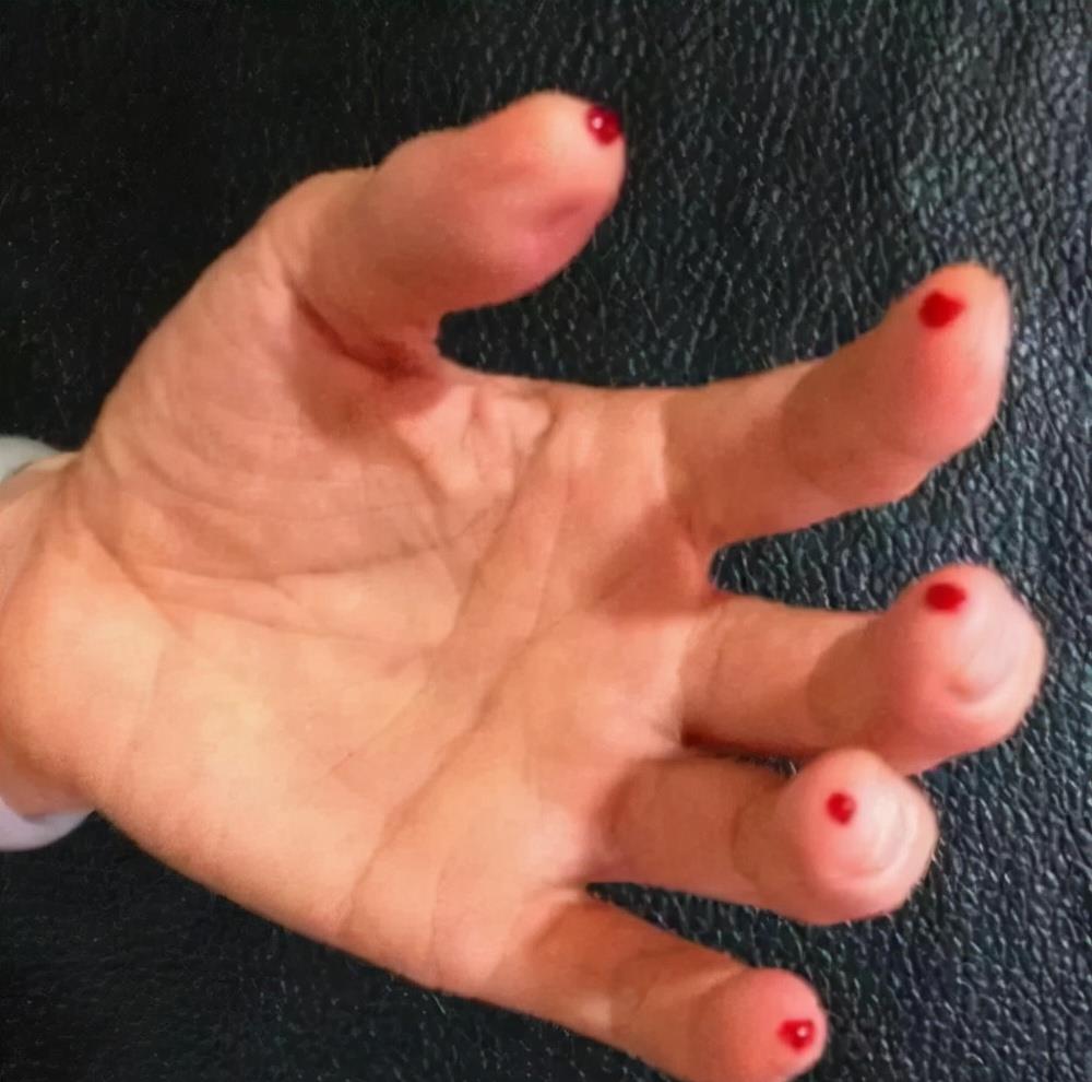 心肌梗塞|突发心梗,10种自救方法!您会选择哪几条?留言告诉王医生!