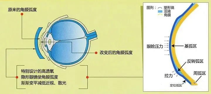 中牟眼健康|眼科科普丨角膜塑形镜