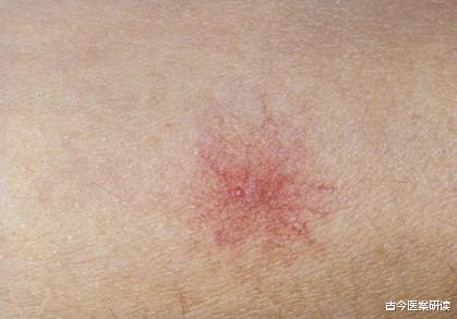 肝硬化|身体出现4个“反常”,别视若无睹,多半肝硬化已上身,早查肝CT