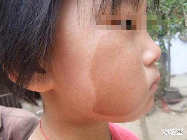 淘娃堂|想让宝宝和胎记说拜拜! 大夫: 孕期, 孕妇一定要躲开这种行为