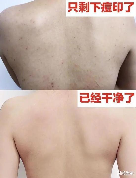 时尚美妆|刘亦菲也曾“跌下神坛”，只因后背长痘，长得好皮肤差是啥体验？