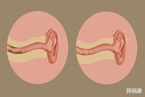 外耳道|耳朵总是痒，什么原因？不一定是耳屎多，养护耳朵的方法学一下