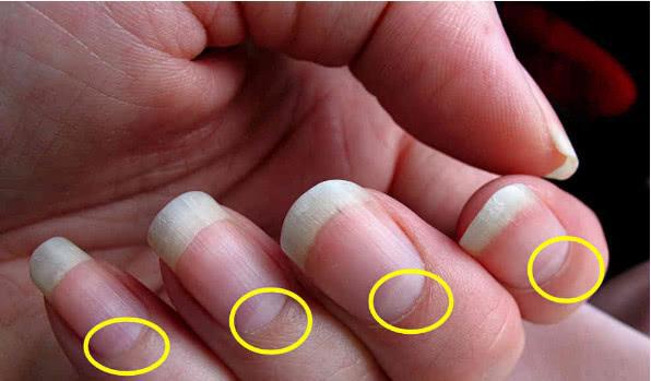 清源净流|手部灰指甲有哪些因素引起?一个家庭小妙招,赶走灰指甲!