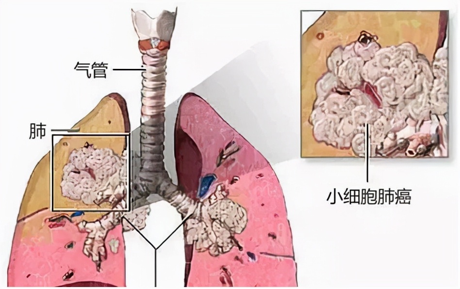 家属说|病灶完全消失，自发缓解！或许跟这三种原因有关！