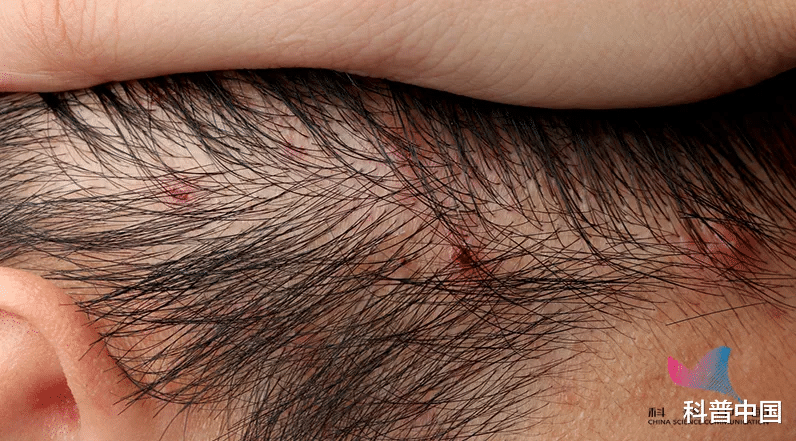 痘痘|头皮上长的\小疙瘩\到底是啥?该如何预防?答案全在这…