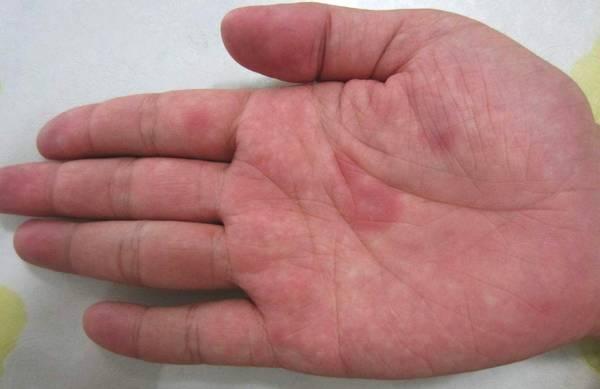 铠甲护士|肠胃好不好,手上能看出来吗?那么手上都有哪些表现呢?