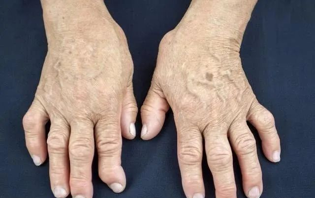 类风湿关节炎|风湿性关节炎和类风湿性关节炎的区别【中国医学传播网】