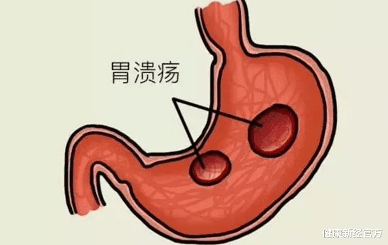 胃溃疡|28岁老师患胃溃疡，半年后恢复正常，医生：1物吃一次相当于8斤山药！