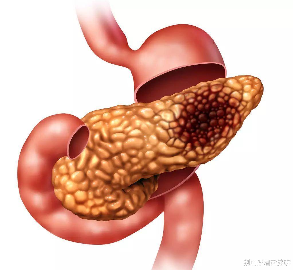 荆山浮屠话健康|为何胰腺癌早期不易发现？六类高危人群，有无症状与肿瘤位置有关