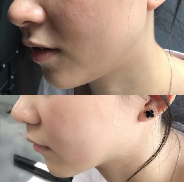 好物官|为什么不建议女生打“美白针”？专家说出实情，网友：幸好没跟风