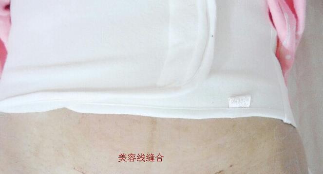 运动|剖腹产是美容线好还是普通线好？区别有3点，产妇早知道早预防