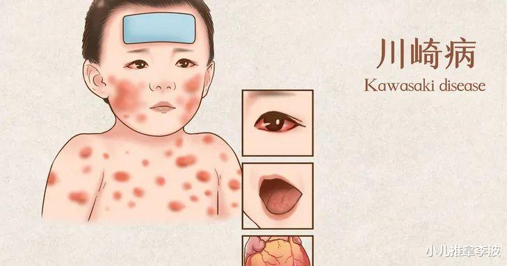 小儿推拿李波|小儿推拿李波：儿童高烧不退，警惕川崎病！有哪些症状？如何应对