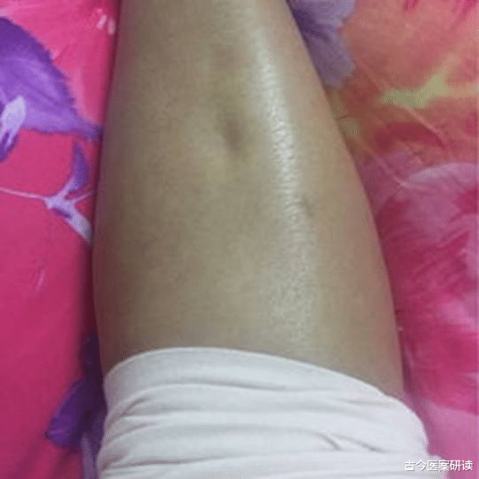 古今医案研读|39岁男子尿酸680，肾衰竭入院！医生警告：出现3个症状，赶快降尿酸