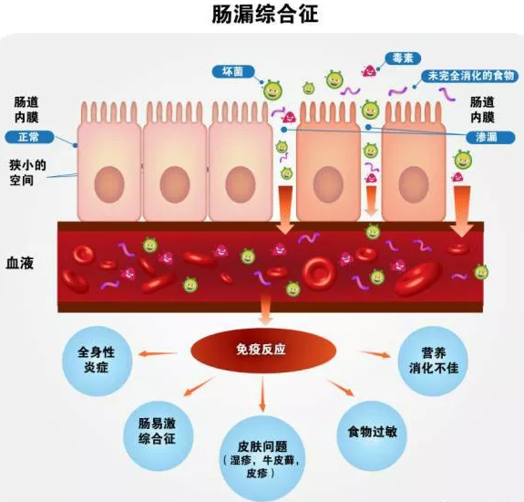 黎明扭转乾坤|什么是肠漏？肠漏引起脂肪肝、糖尿病的机理是什么？
