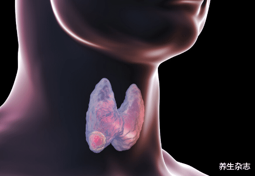 甲状腺癌|?35岁男子烟酒不沾，确诊甲状腺癌，医生惋惜：1个饮食习惯害了他