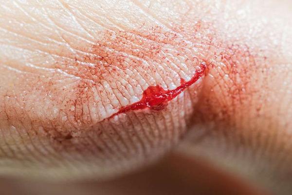 高血糖|血糖升高时，身体或出现这5种不适，需重视，以免血糖失控