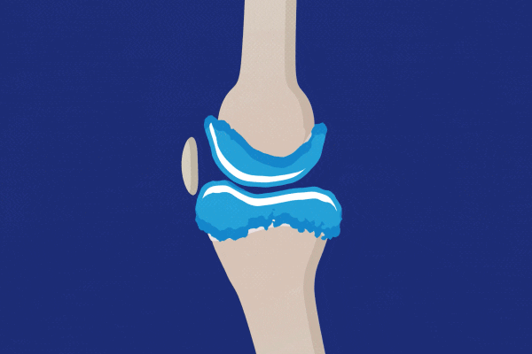 杭吉干细胞科技|骨关节炎找上门该怎么办？干细胞让你远离关节疼痛