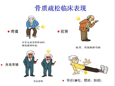 医学小栈|骨质疏松，别等50岁才开始防！医生建议4个补钙良方
