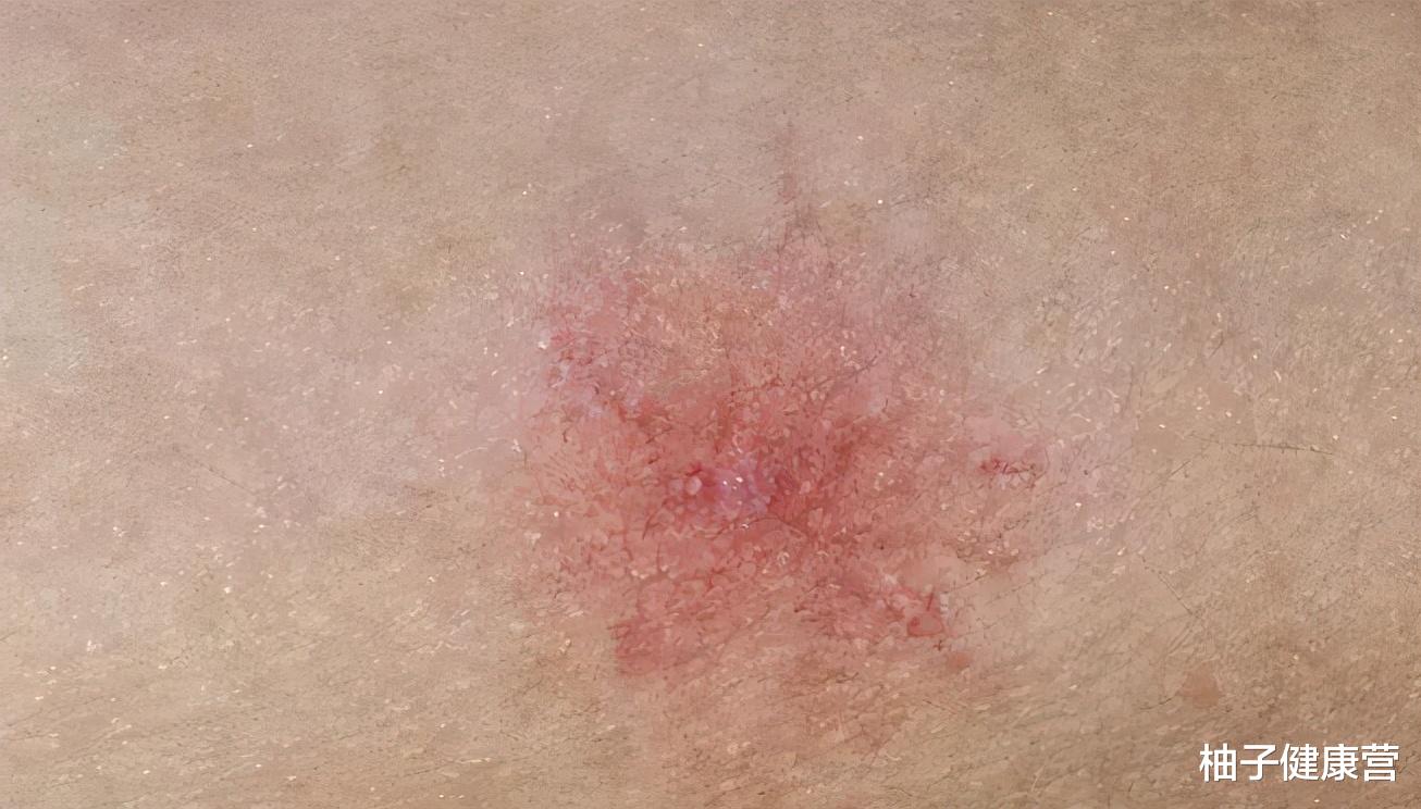 柚子健康营|肝脏不好的人群,要警惕皮肤的4种变化,若发现异样,及时检查