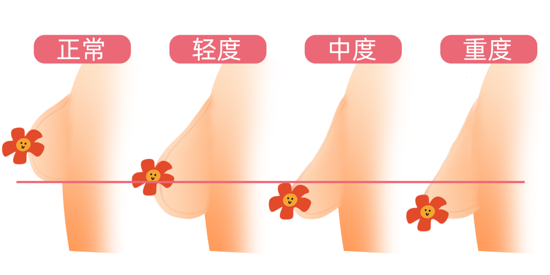 中国医学传播网|有人忙着花钱隆胸，有人却巴不得胸小一点……