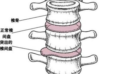 养生|引起腰椎间盘突出的主要原因及注意事项！邱氏悬壶