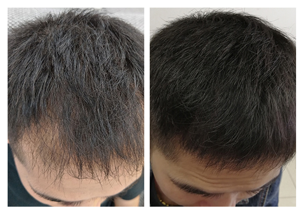 |最容易脱发的TOP5职业知道吗