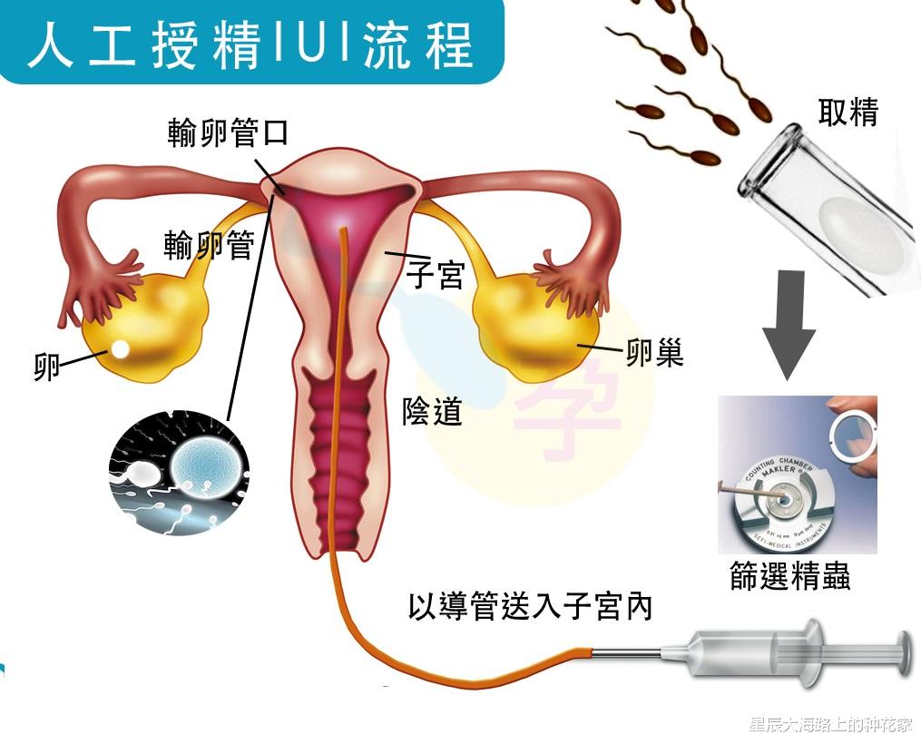 人工授精 看呆医生：一次成功！嫌医院人工授精太贵，英女子硬核DIY操作