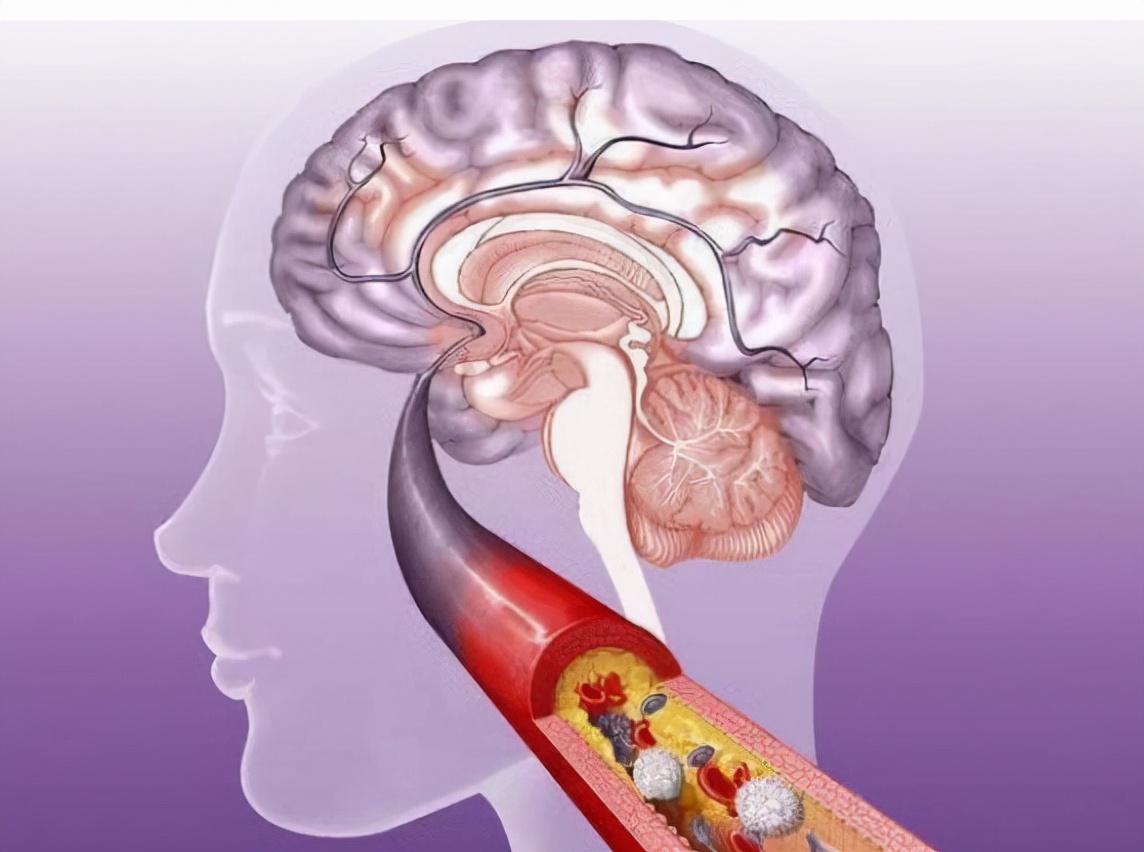 脱发|脑梗“提速器”已公布，肥肉排最后，第一名大家几乎天天吃