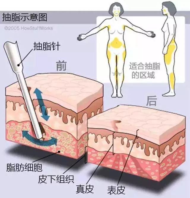 穿衣搭配|常见的手术减肥方法有哪些？丨科普篇