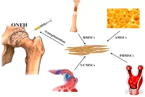 领蔚生物 量身定制：新型干细胞疗法，改善股骨头坏死患者的疼痛和功能