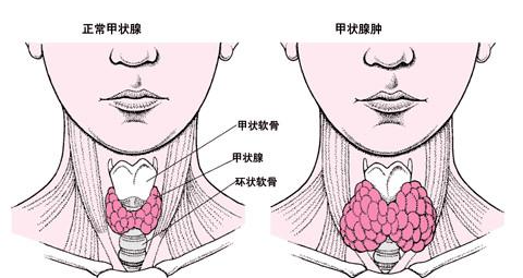 甲状腺结节|日本女性很少得甲状腺结节，或许是这三个好习惯帮助了她们，我们也可以学习一下