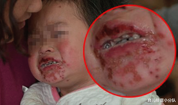 辣条|小女孩脸部成“烂柿子”,只因这种零食吃太多,父母管好娃别常买