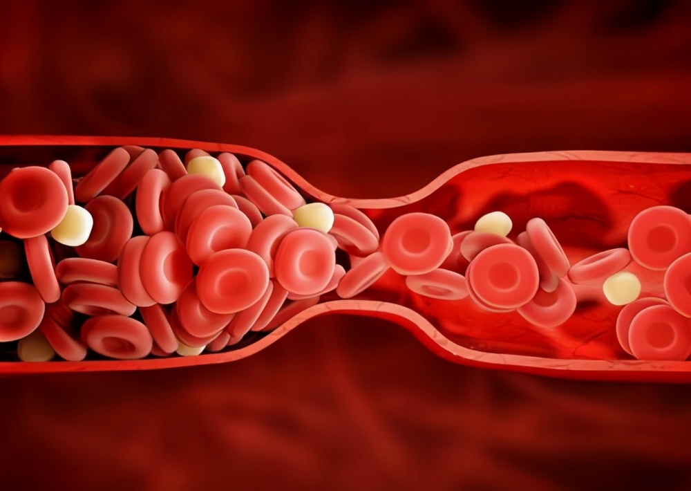 金兰中医学社|“血栓克星”已公布,很多人爱吃,经常吃一点,血栓或能慢慢溶解
