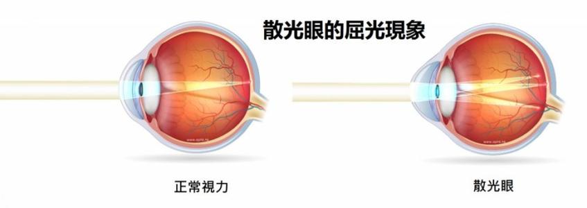 近视|散光配镜存在什么误区?