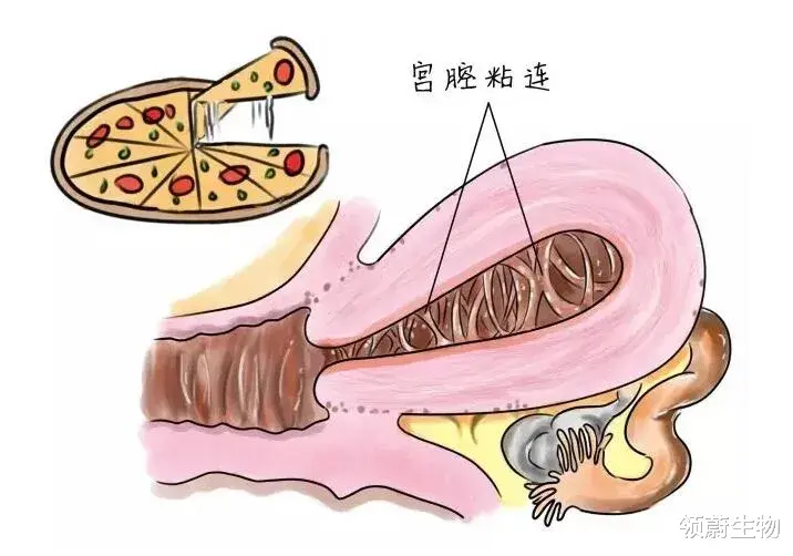 领蔚生物|化身送子观音，干细胞让宫腔粘连患者成功受孕