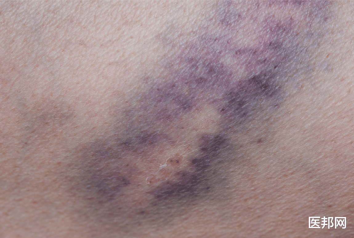 过敏|腿上青一块紫一块，是过敏性紫癜吗？教你辨别