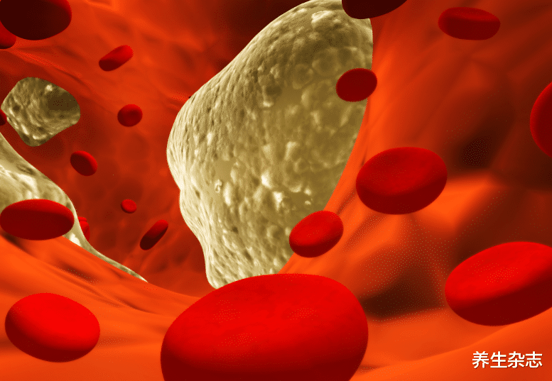疾病|65岁大爷血脂从8.4到3.2,医生:2物是血管“清洁剂”,别不舍得吃