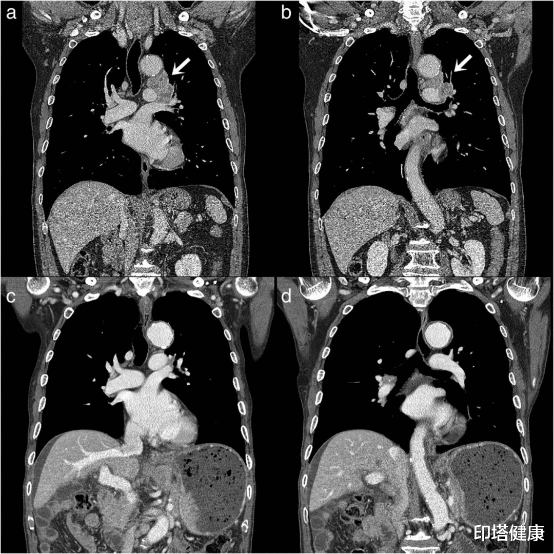 印塔健康|小细胞肺癌患者在未经任何治疗的情况下完全自发缓解