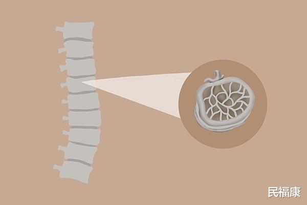 补钙|年龄增长，钙流失加快？中老年补钙，预防骨质疏松，时刻要进行
