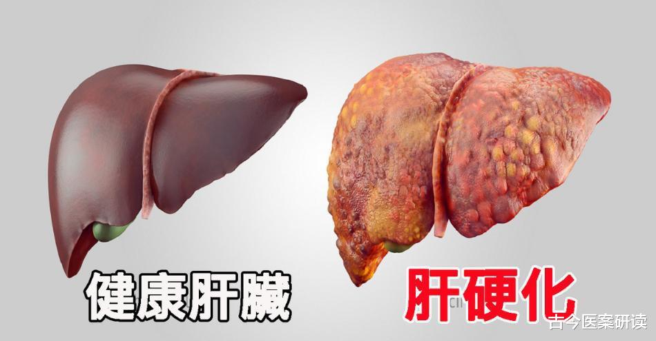 古今医案研读|46岁男子突发肝硬化住院，只因平时的三个坏习惯，大多数人不在意